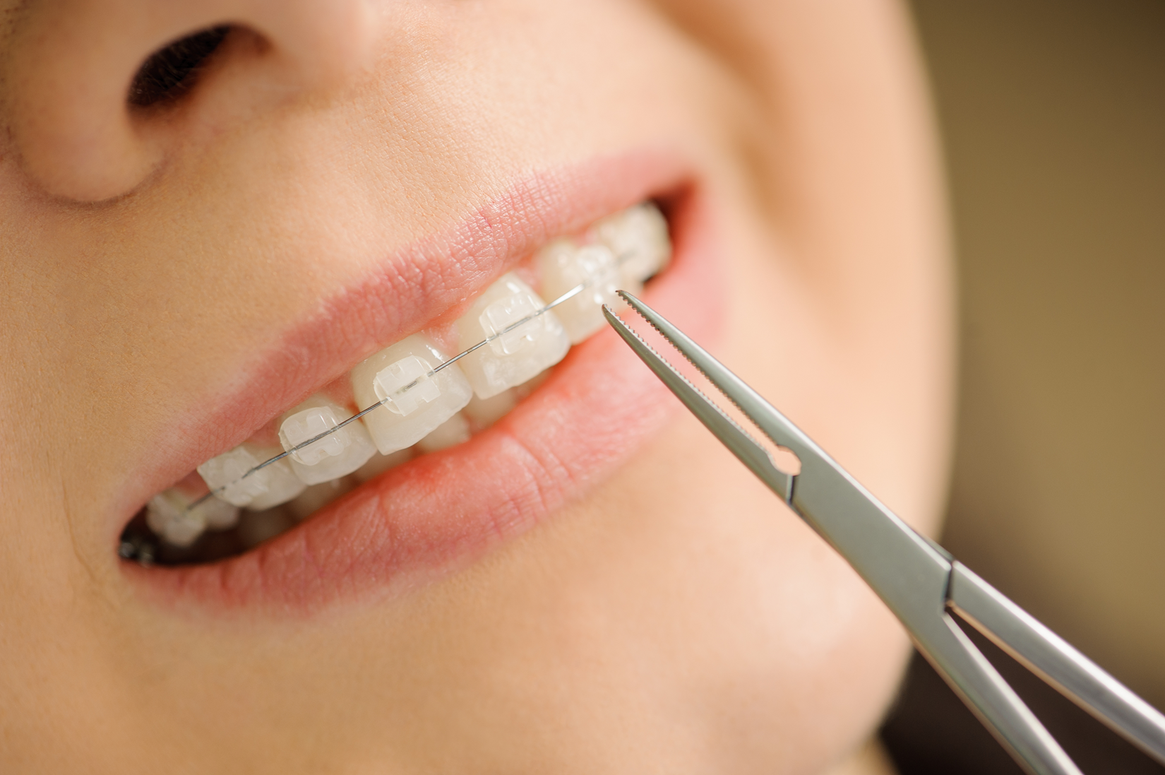 Ceramic Braces Ceramic Braces