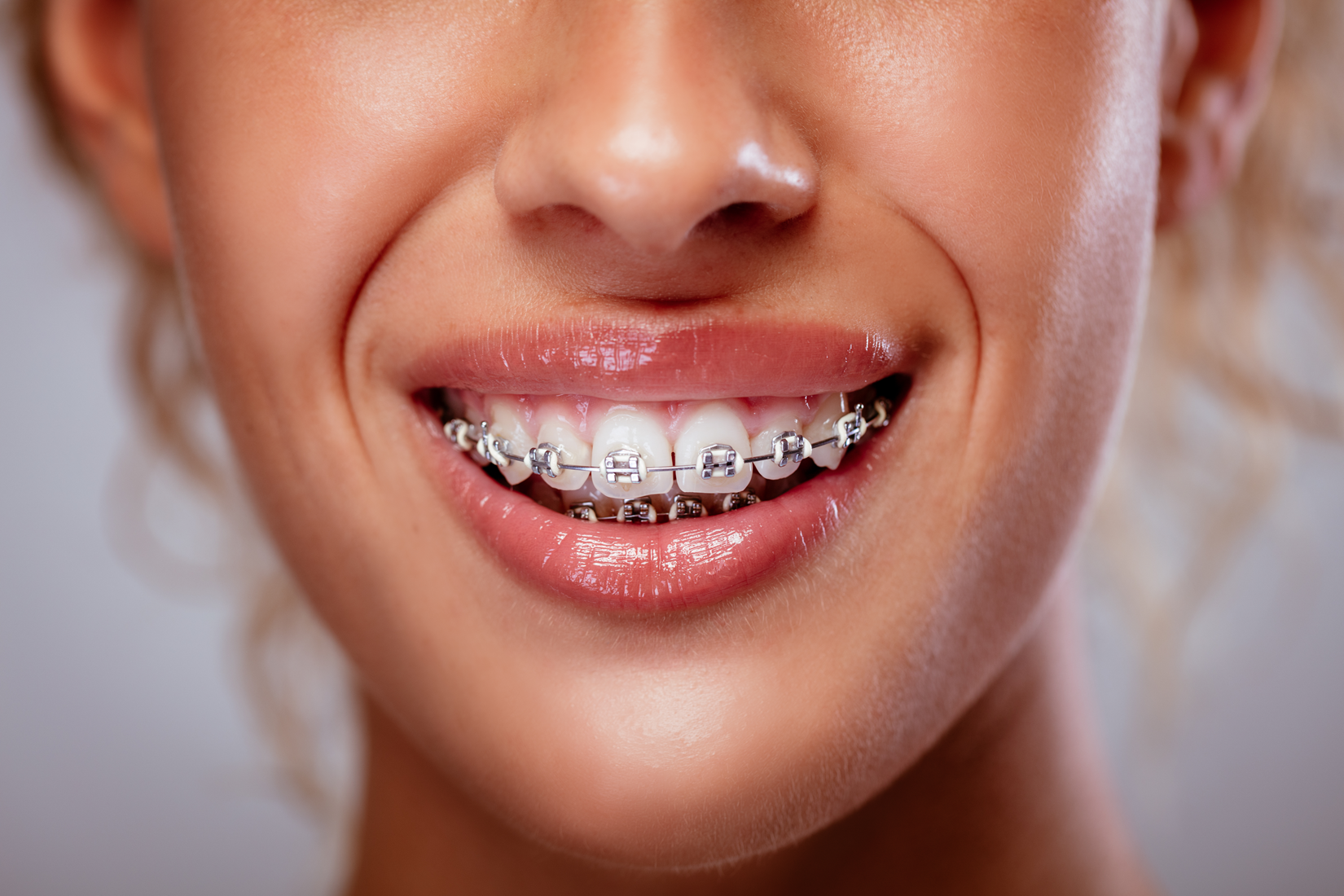 Metal Braces Metal Braces