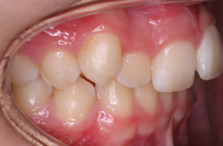 Alaina Burke 05-Buccal Right Alaina Burke 05-Buccal Right