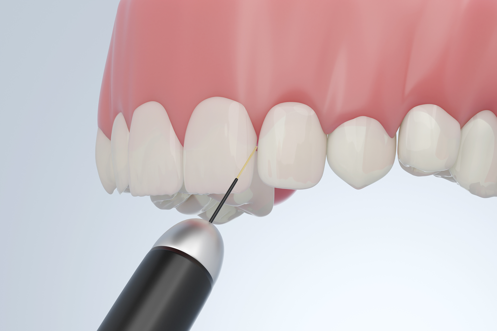 Diode Laser Treatment Diode Laser Treatment