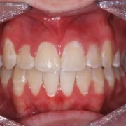 Spacing of teeth_2 Spacing of teeth_2
